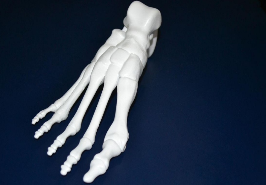 3D打印骨骼模型给患者的康复指南