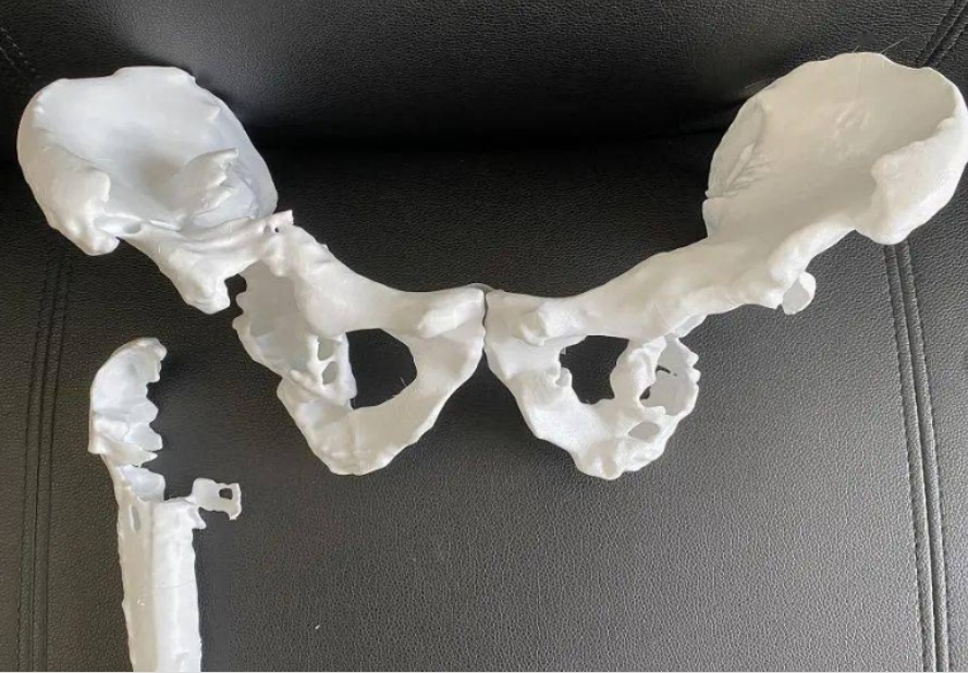 3D打印椎骨给脊柱手术装个安全保险